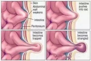 新生儿肚脐夹怎么打开婴儿肚脐凸出来要用带子、硬币压吗？宝宝脐疝像这样护理最靠谱_https://www.jmylbn.com_新闻资讯_第4张