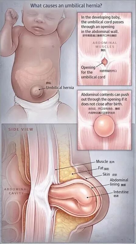 新生儿肚脐夹怎么打开婴儿肚脐凸出来要用带子、硬币压吗？宝宝脐疝像这样护理最靠谱_https://www.jmylbn.com_新闻资讯_第3张