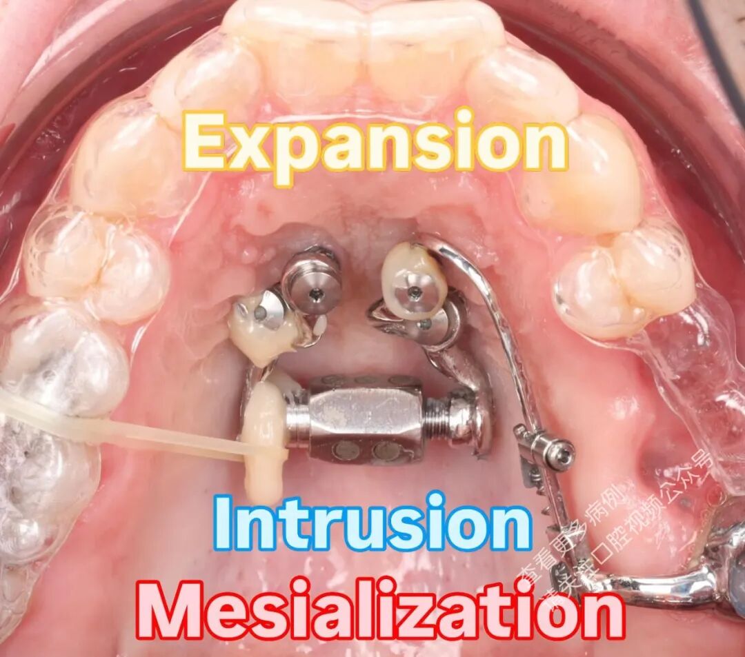这样的正畸操作，你见过吗