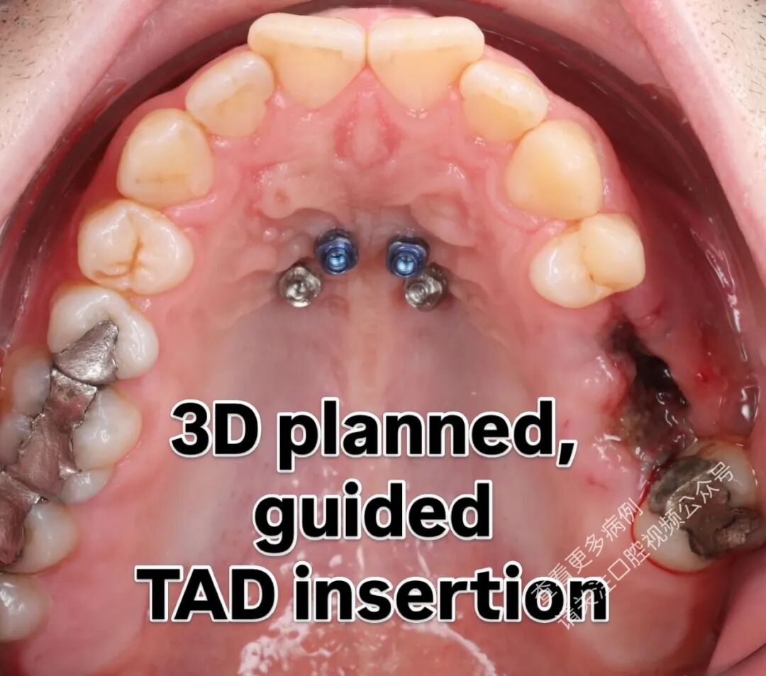 这样的正畸操作，你见过吗