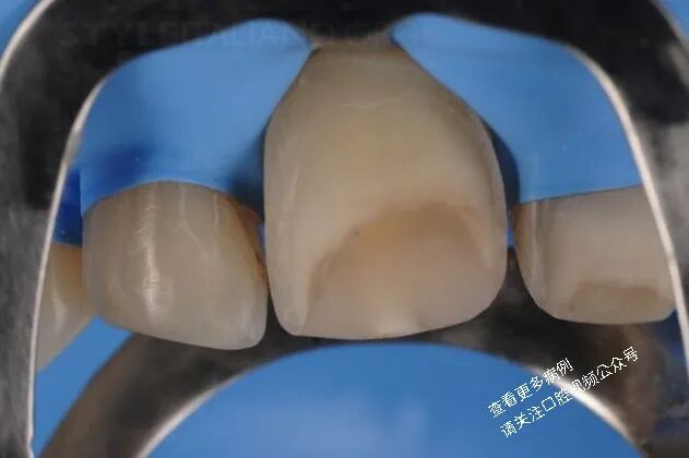 贴面粘接流程：从酸蚀到抛光全步骤（28图详解）