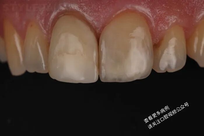 贴面粘接流程：从酸蚀到抛光全步骤（28图详解）