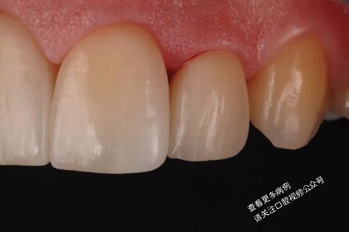 贴面粘接流程：从酸蚀到抛光全步骤（28图详解）