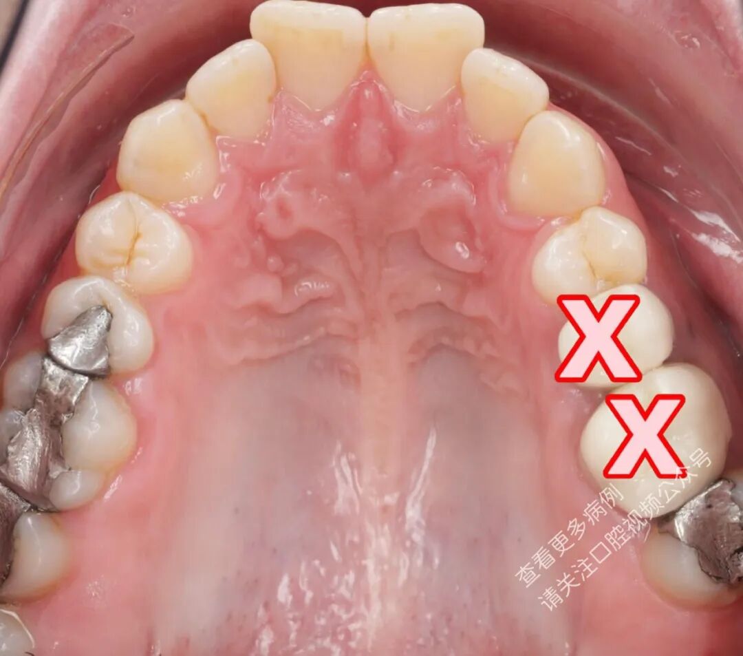 这样的正畸操作，你见过吗