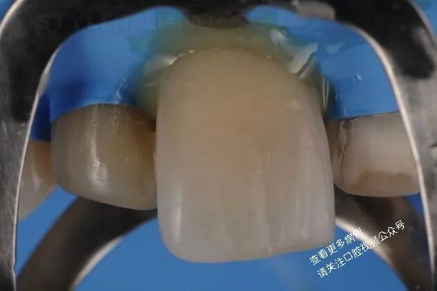 贴面粘接流程：从酸蚀到抛光全步骤（28图详解）