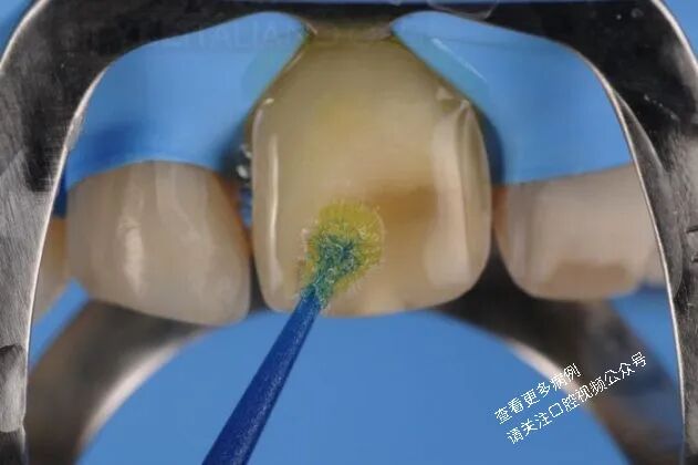 贴面粘接流程：从酸蚀到抛光全步骤（28图详解）