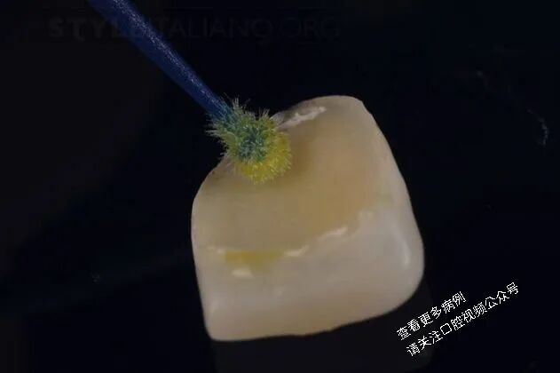 贴面粘接流程：从酸蚀到抛光全步骤（28图详解）