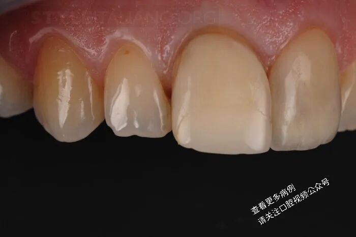 贴面粘接流程：从酸蚀到抛光全步骤（28图详解）