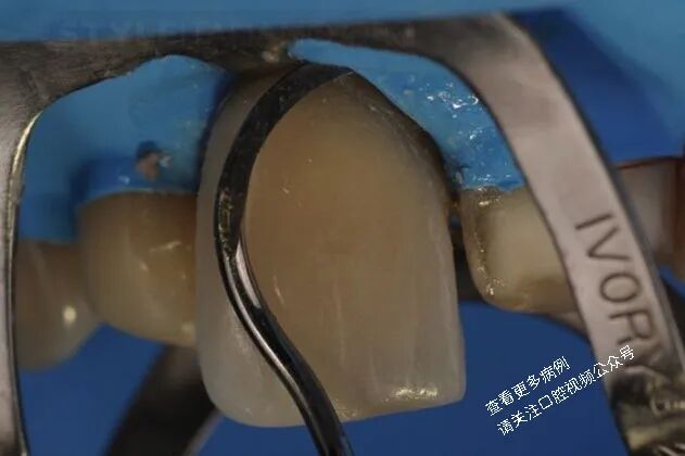 贴面粘接流程：从酸蚀到抛光全步骤（28图详解）