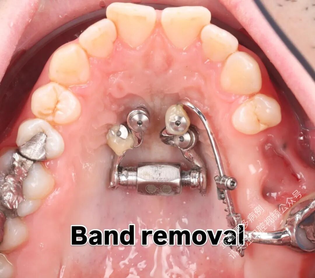 这样的正畸操作，你见过吗