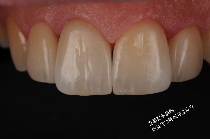 贴面粘接流程：从酸蚀到抛光全步骤（28图详解）