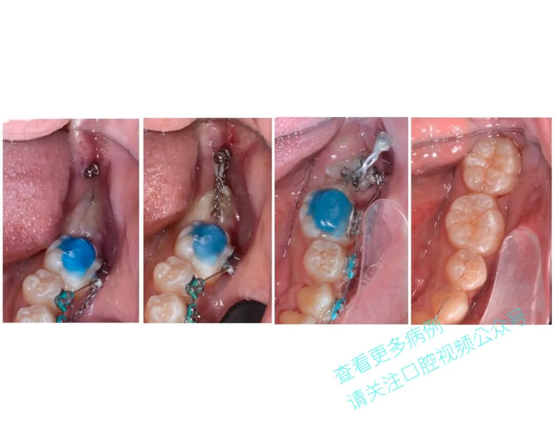 一位顶尖牙医的处理，思路是亮点