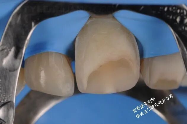 贴面粘接流程：从酸蚀到抛光全步骤（28图详解）