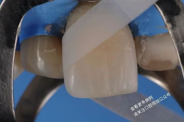 贴面粘接流程：从酸蚀到抛光全步骤（28图详解）