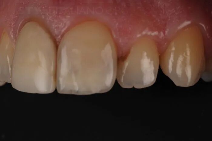 贴面粘接流程：从酸蚀到抛光全步骤（28图详解）