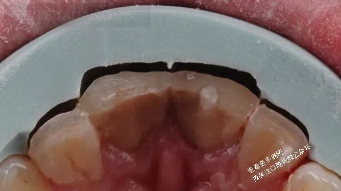贴面粘接流程：从酸蚀到抛光全步骤（28图详解）