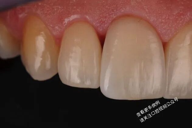 贴面粘接流程：从酸蚀到抛光全步骤（28图详解）