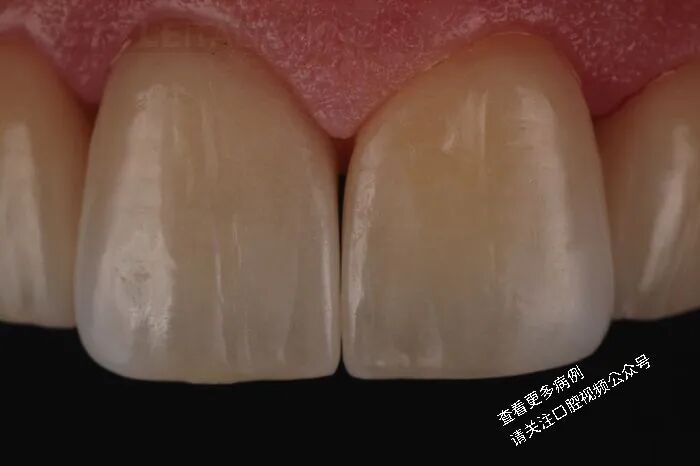 贴面粘接流程：从酸蚀到抛光全步骤（28图详解）