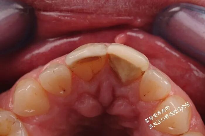 贴面粘接流程：从酸蚀到抛光全步骤（28图详解）