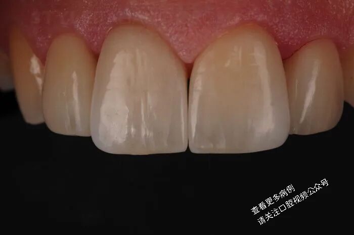 贴面粘接流程：从酸蚀到抛光全步骤（28图详解）