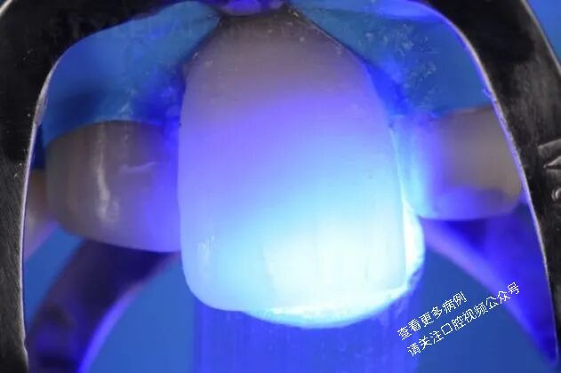 贴面粘接流程：从酸蚀到抛光全步骤（28图详解）