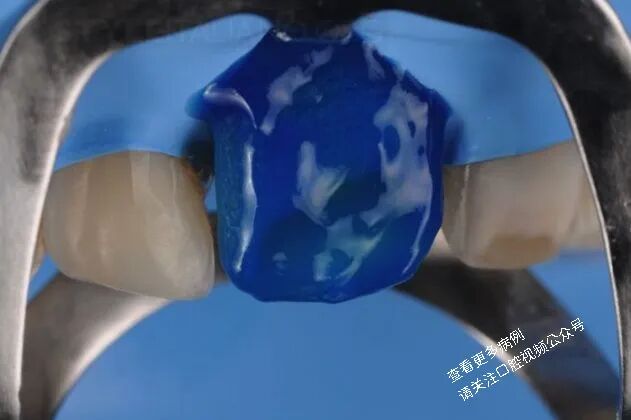 贴面粘接流程：从酸蚀到抛光全步骤（28图详解）