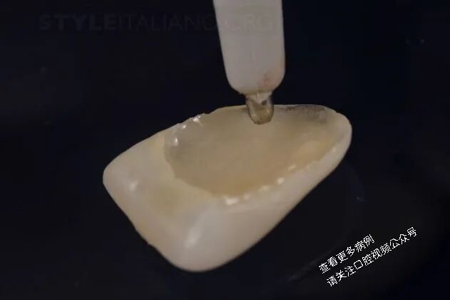 贴面粘接流程：从酸蚀到抛光全步骤（28图详解）