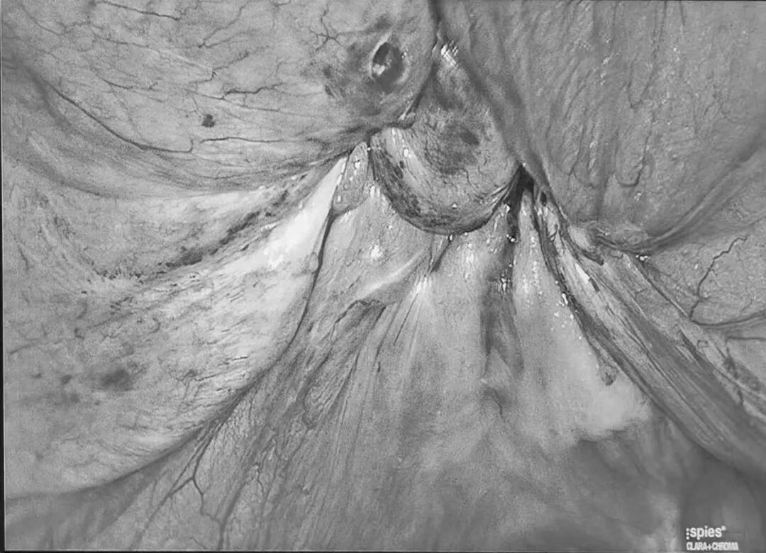 疝气补片怎么用【精业】勿以“疝”小而不为！带您了解第八医院“腹腔镜下腹壁切口疝补片修补术_https://www.jmylbn.com_新闻资讯_第3张