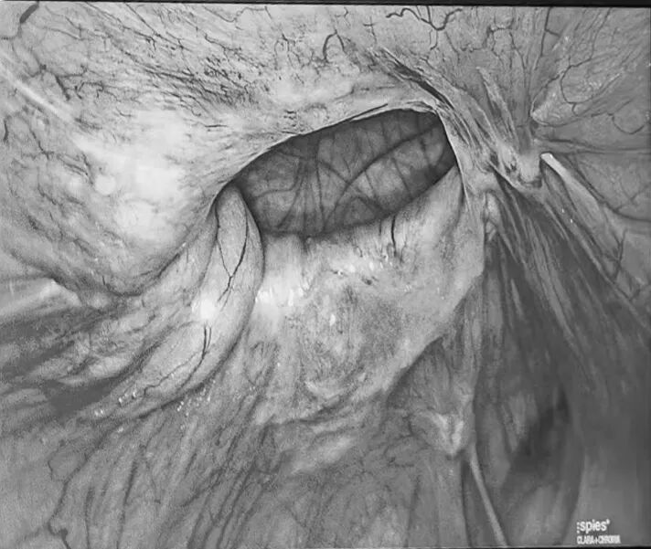 疝气补片怎么用【精业】勿以“疝”小而不为！带您了解第八医院“腹腔镜下腹壁切口疝补片修补术_https://www.jmylbn.com_新闻资讯_第2张