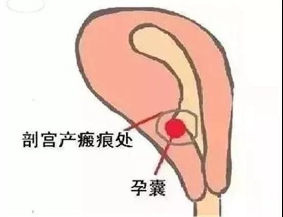 30岁女子喜怀二胎，全家欢庆！医生却说太危险，赶紧打掉！只因…（组图） - 2
