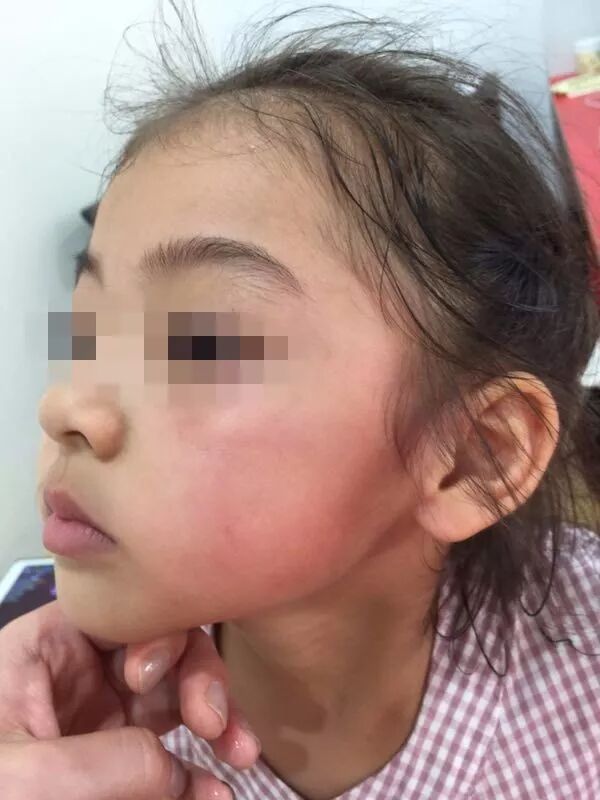 家长护犊掌掴对方小孩致脸肿被拘留作为家长应该控制情绪