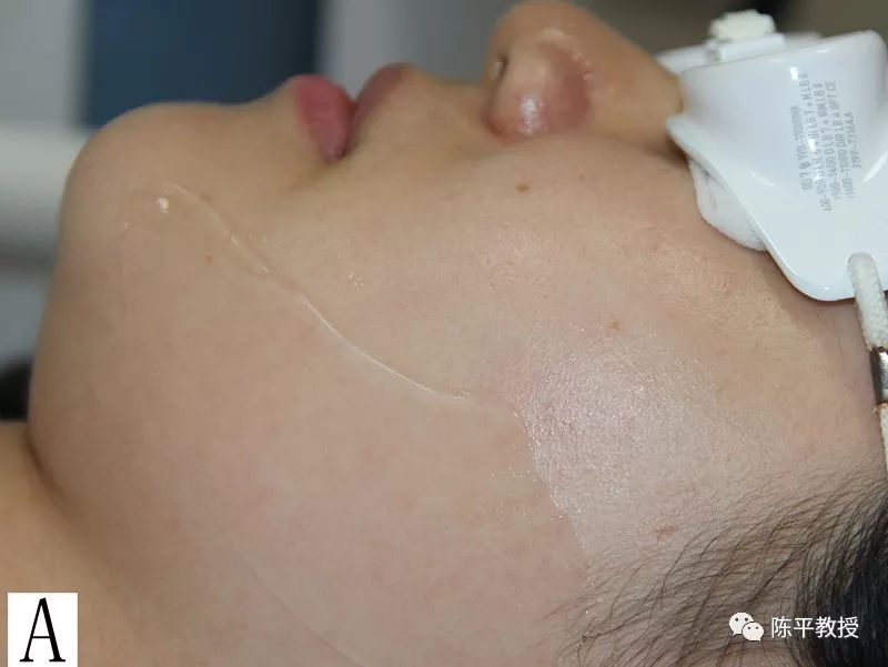 强脉冲光干眼症强脉冲光的参数选择与操作技巧培训——强脉冲光的操作细节和操作技巧
