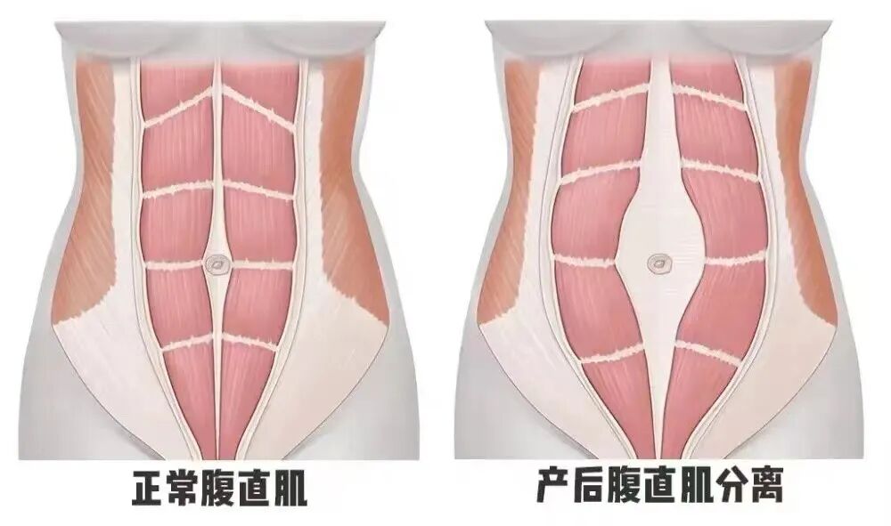 盆地康复仪器怎么用当年没做产后修复, 后悔6年, 找到医院产康仪器, 解决漏尿、腹直肌分离, 孩子妈来看看_https://www.jmylbn.com_新闻资讯_第34张