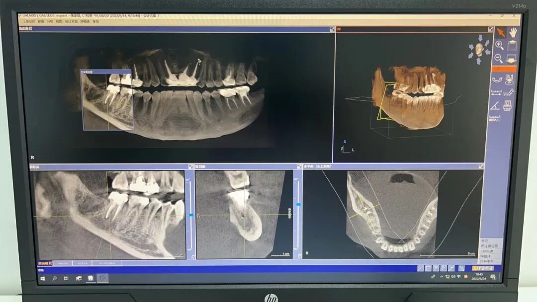 口腔ct怎么拍摄【医院动态】口腔科的“火眼金睛”——CBCT投入使用_https://www.jmylbn.com_新闻资讯_第6张