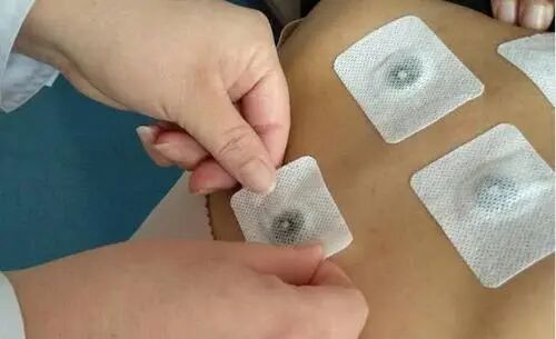 中医适宜技术——穴位敷贴