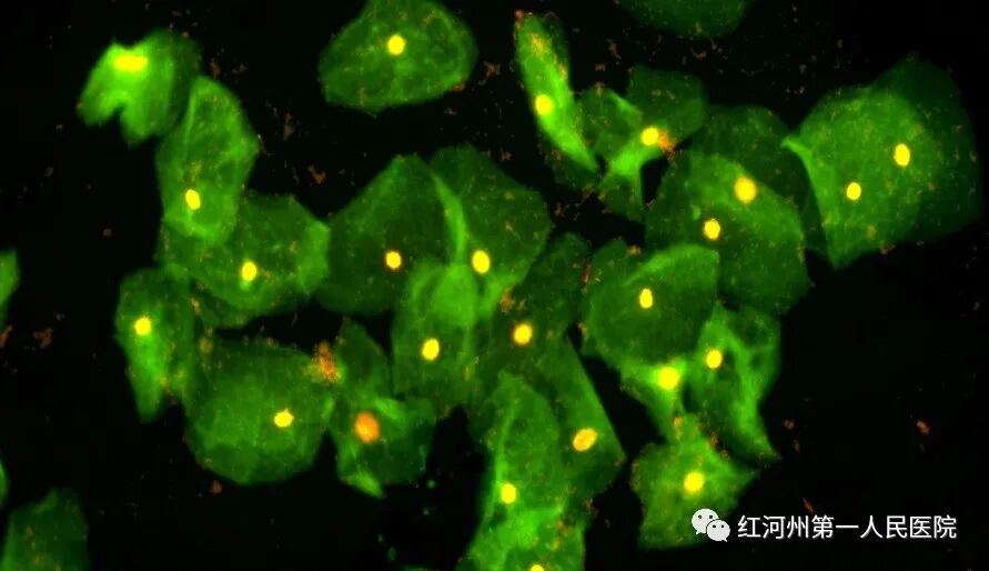 妇科荧光检查是什么生殖道分泌物细菌及真菌联合检测，为女性带来福音_https://www.jmylbn.com_新闻资讯_第8张