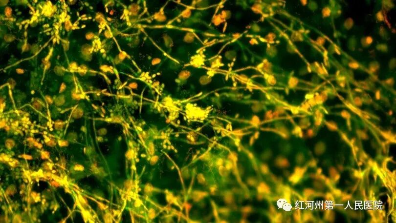 妇科荧光检查是什么生殖道分泌物细菌及真菌联合检测，为女性带来福音_https://www.jmylbn.com_新闻资讯_第7张