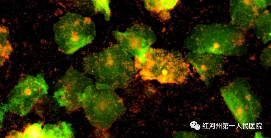 妇科荧光检查是什么生殖道分泌物细菌及真菌联合检测，为女性带来福音_https://www.jmylbn.com_新闻资讯_第14张