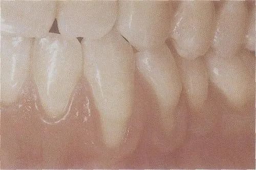 牙齿的“黑三角”，比蛀牙还可怕