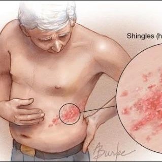 【健康科普】老年人面对带状疱疹的“偷袭”，难道只能无奈“躺平”？
