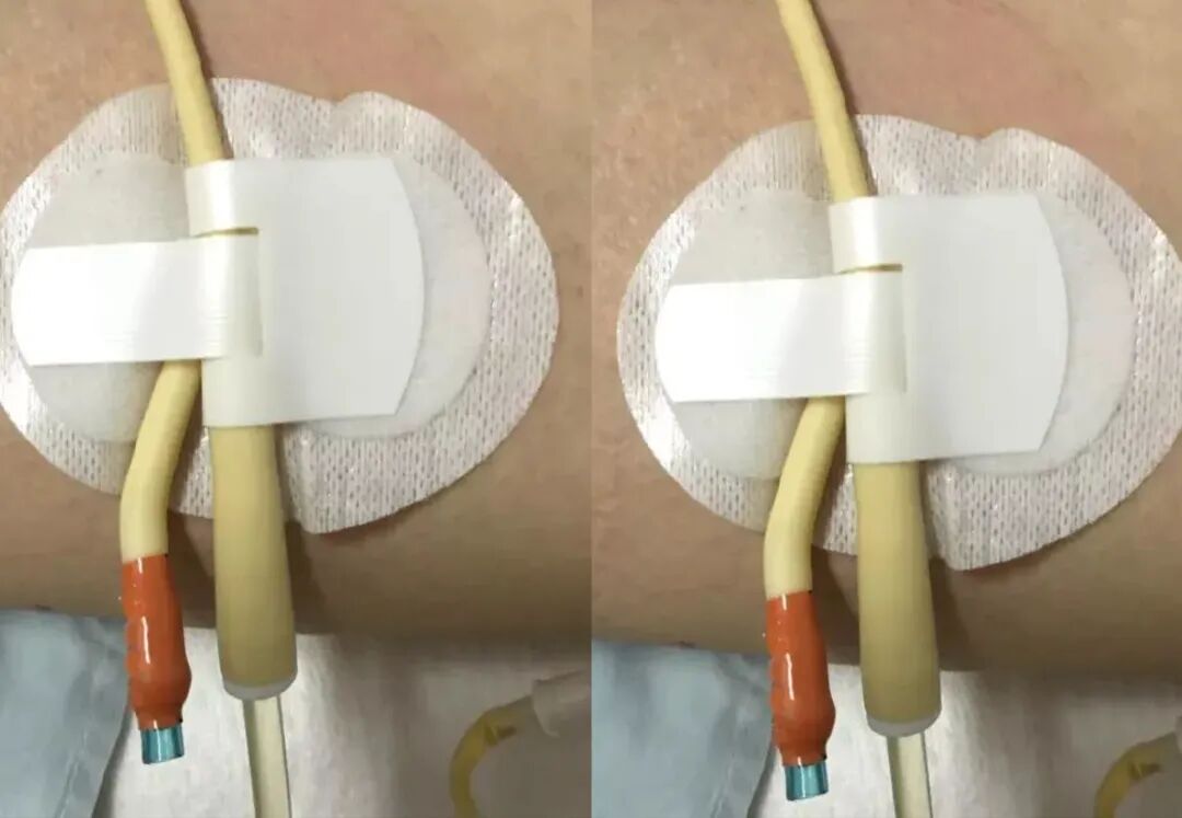 尿管怎么固定常见导管固定，T型、I型、Y型法_https://www.jmylbn.com_新闻资讯_第11张