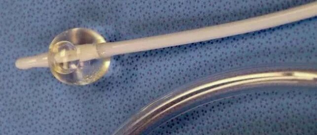 尿管竟然插到了阴道里？！还打了80毫升水，后来……