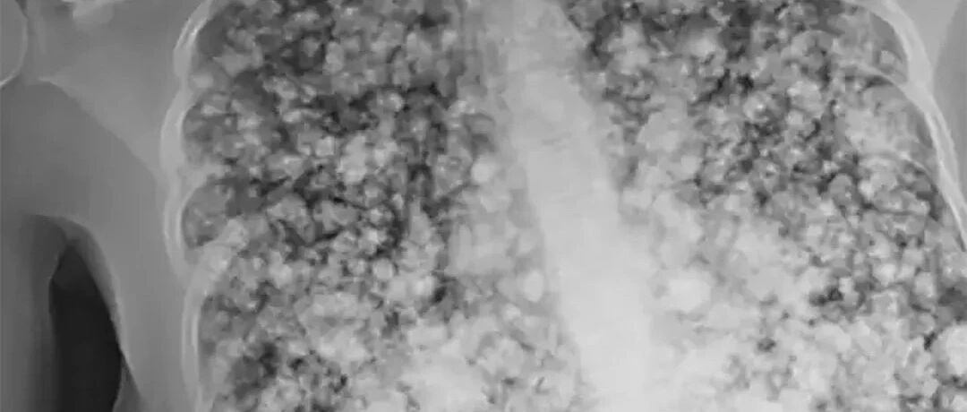 17岁少年肺被炸成爆米花，罪魁祸首也许你家也有!