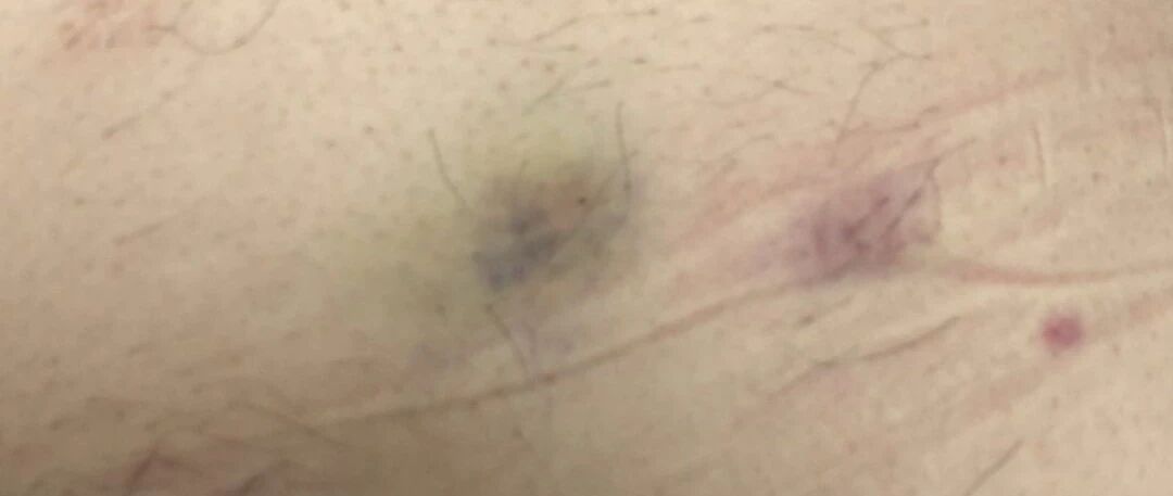 护士，我才扎三针低分子肝素，肚子就青了！