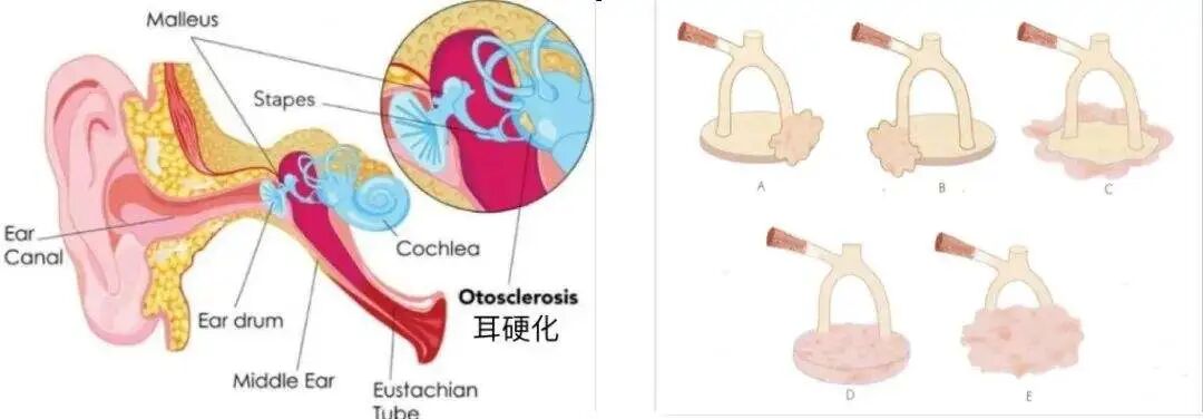 【聽(tīng)力科普】骨導：“外耳中耳與我無(wú)關(guān)？”(圖3)