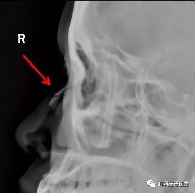 脆弱的鼻骨 耳科王璟医生 微信公众号文章阅读 Wemp