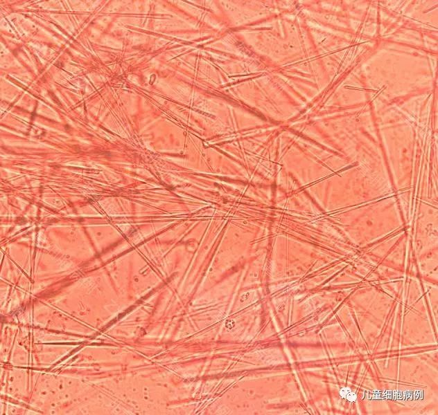 【儿童检验乐园】9 小结晶大问题，不可忽视的尿结晶
