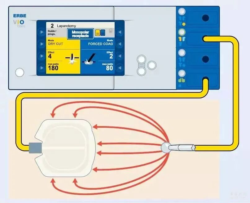 单极为什么要贴负极板电外科干货｜单极电刀的安全使用_https://www.jmylbn.com_新闻资讯_第4张