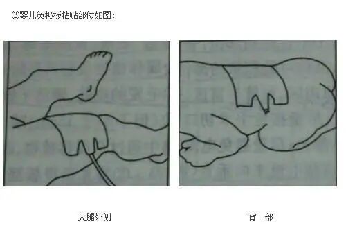 单极为什么要贴负极板电外科干货｜单极电刀的安全使用_https://www.jmylbn.com_新闻资讯_第9张