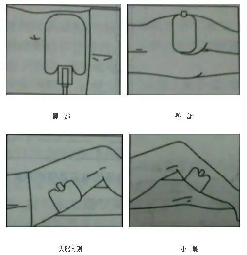 单极为什么要贴负极板电外科干货｜单极电刀的安全使用_https://www.jmylbn.com_新闻资讯_第8张